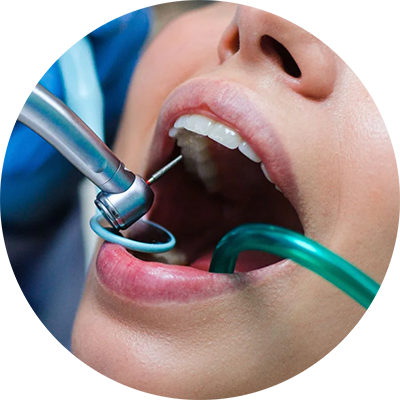 Medico specialista di DentalPiù durante una procedura di endodonzia per trattare un'infiammazione dei tessuti interni del dente causata da carie profonde o fratture, utilizzando tecniche moderne che preservano il dente senza ricorrere all'estrazione