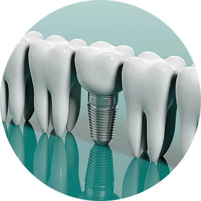 Medico di DentalPiù Sassari, Sanluri e Nuoro esegue un intervento di implantologia per ripristinare i denti persi in sole 24 ore, applicando anche la tecnica 'All in Four' per entrambe le arcate in meno di 12 ore con soli quattro impianti