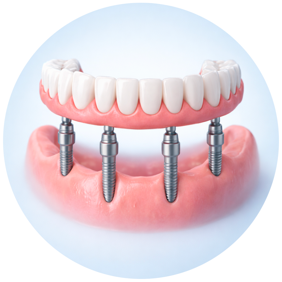 Protesi dentarie su misura per riabilitazione del sorriso